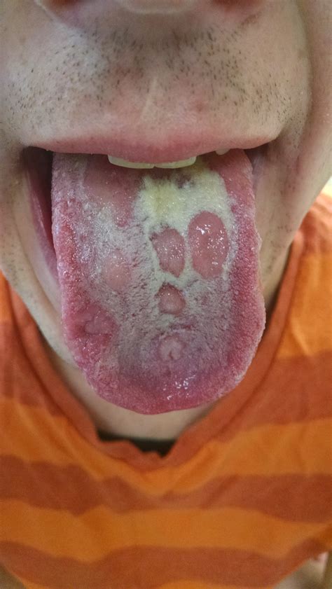 sifilis lingua